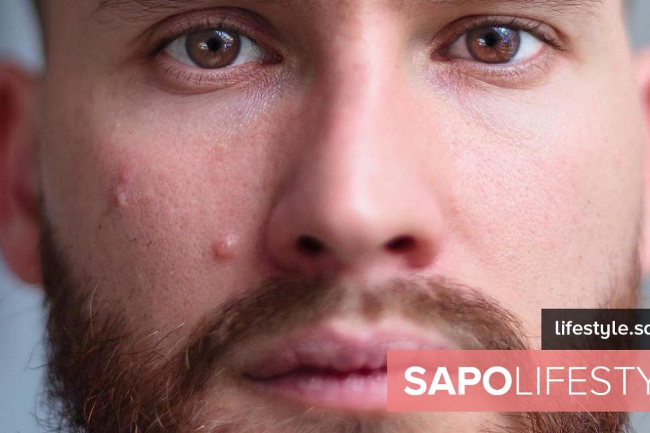 10 dicas para tratar a acne – condicionamento físico e saúde