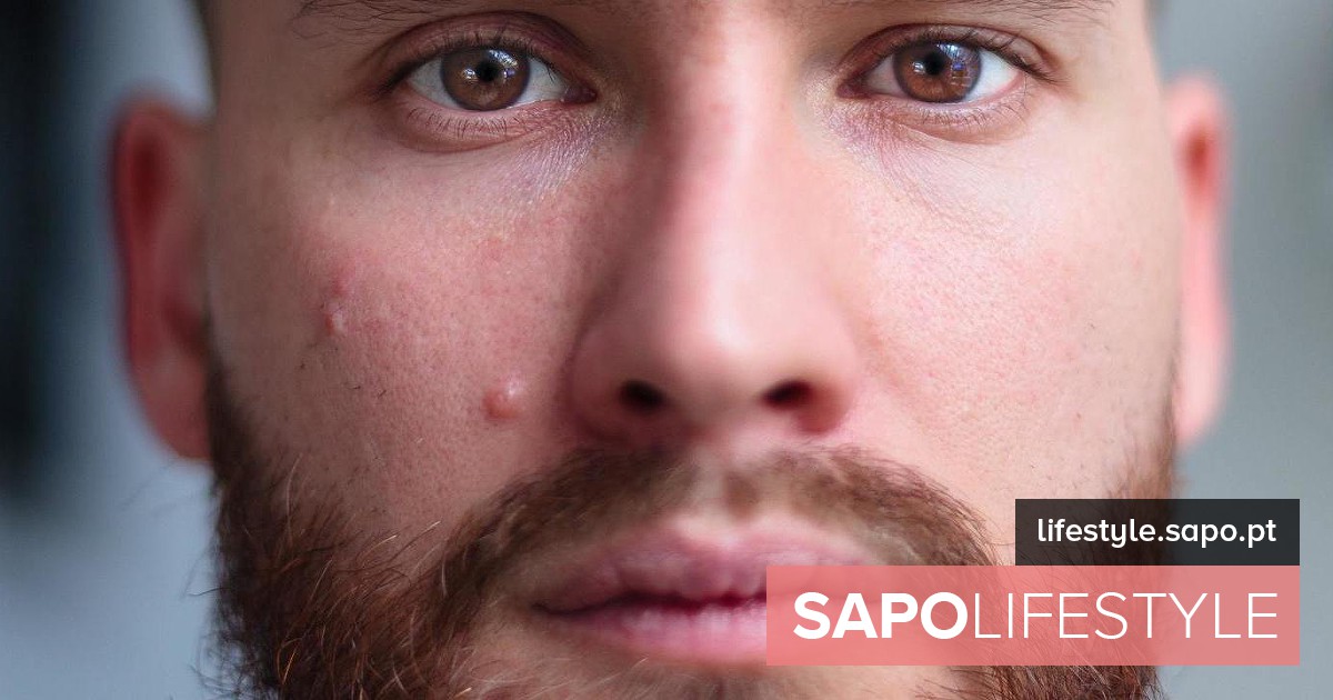 10 dicas para tratar a acne – condicionamento físico e saúde