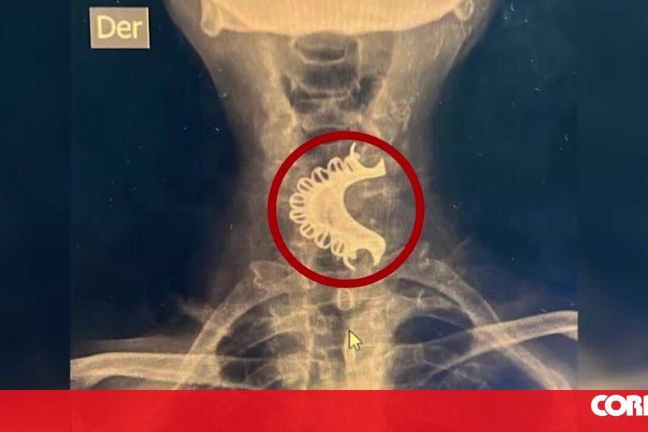 Homem teve que passar por cirurgia após engolir dentadura e ficar preso na garganta