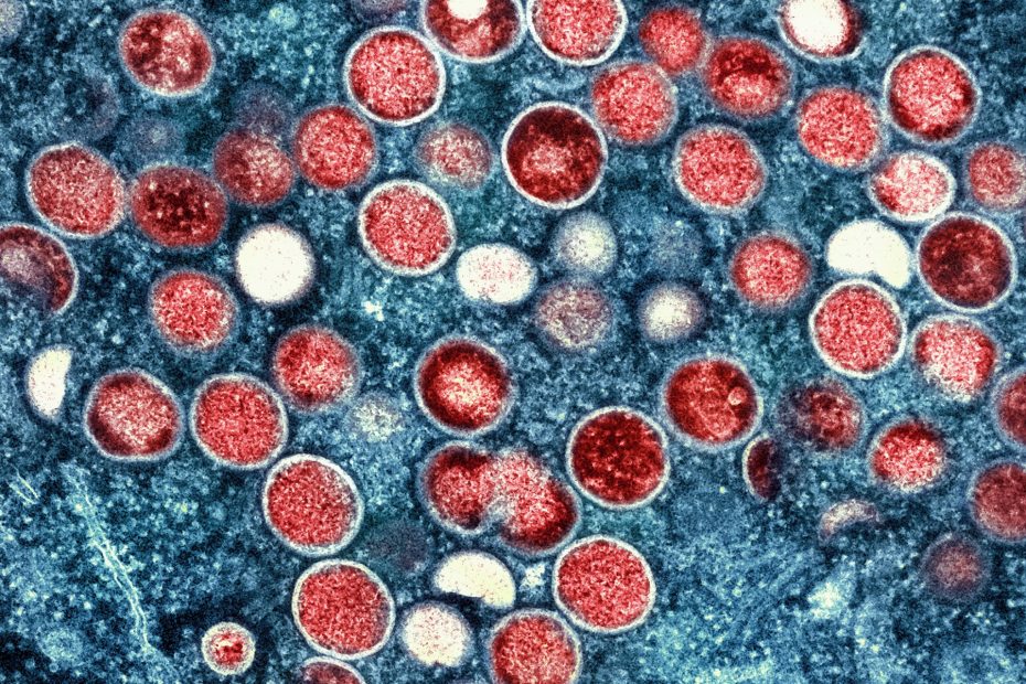 Sierra Leone declares state of emergency over MPOX outbreak | Health News