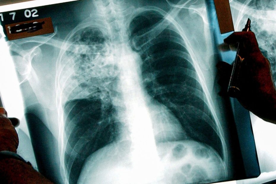 The outbreak of tuberculosis that killed twice in Kansas