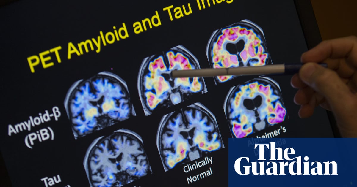 Australia approves new drugs for early stage Alzheimer's disease | Alzheimer's disease
