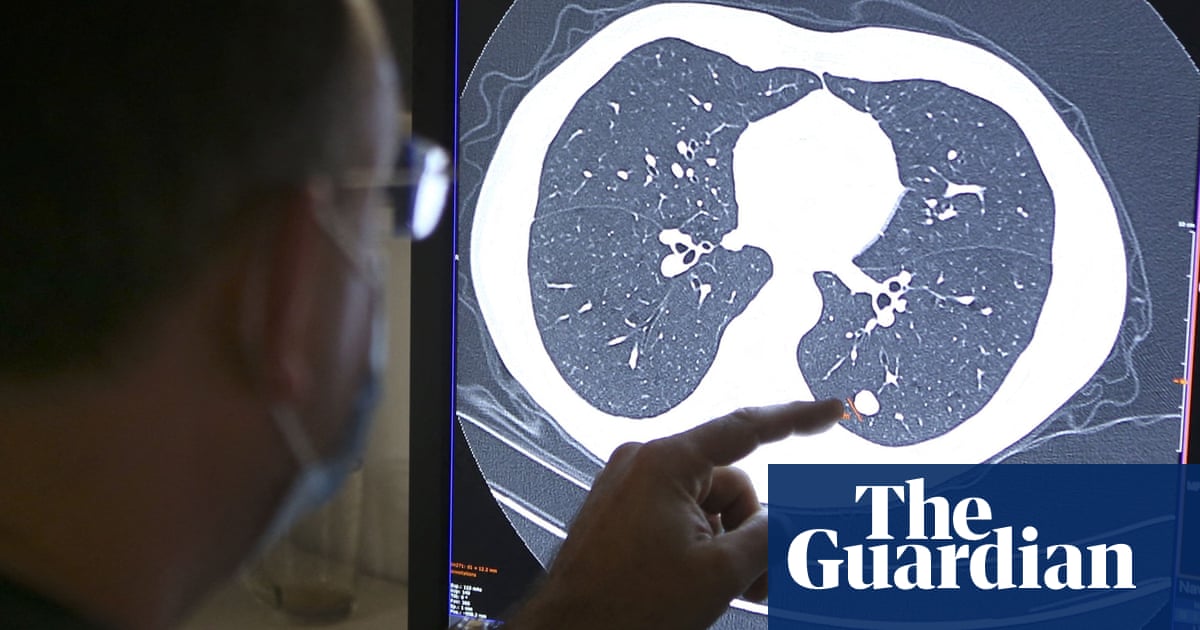 England's NHS urges to become an “early intervention service” for cancer | Cancer