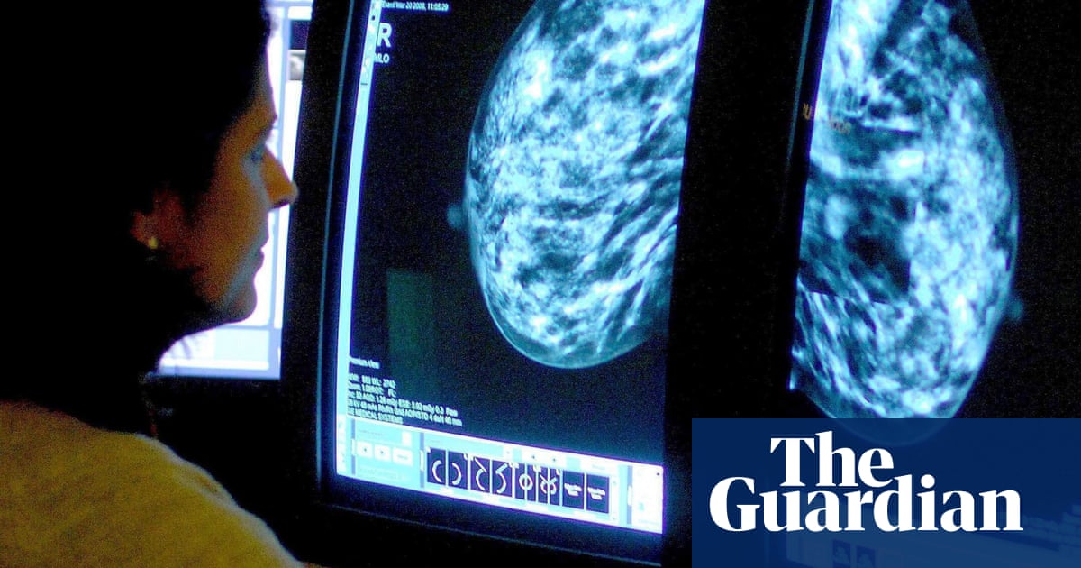 Extra cancer scans for women with dense breasts can save 700 lives a year – UK Research | Breast Cancer