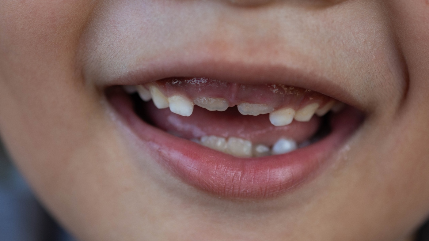 FDA moves to ban children's fluoride supplements, removing key tools for dentists: lenses