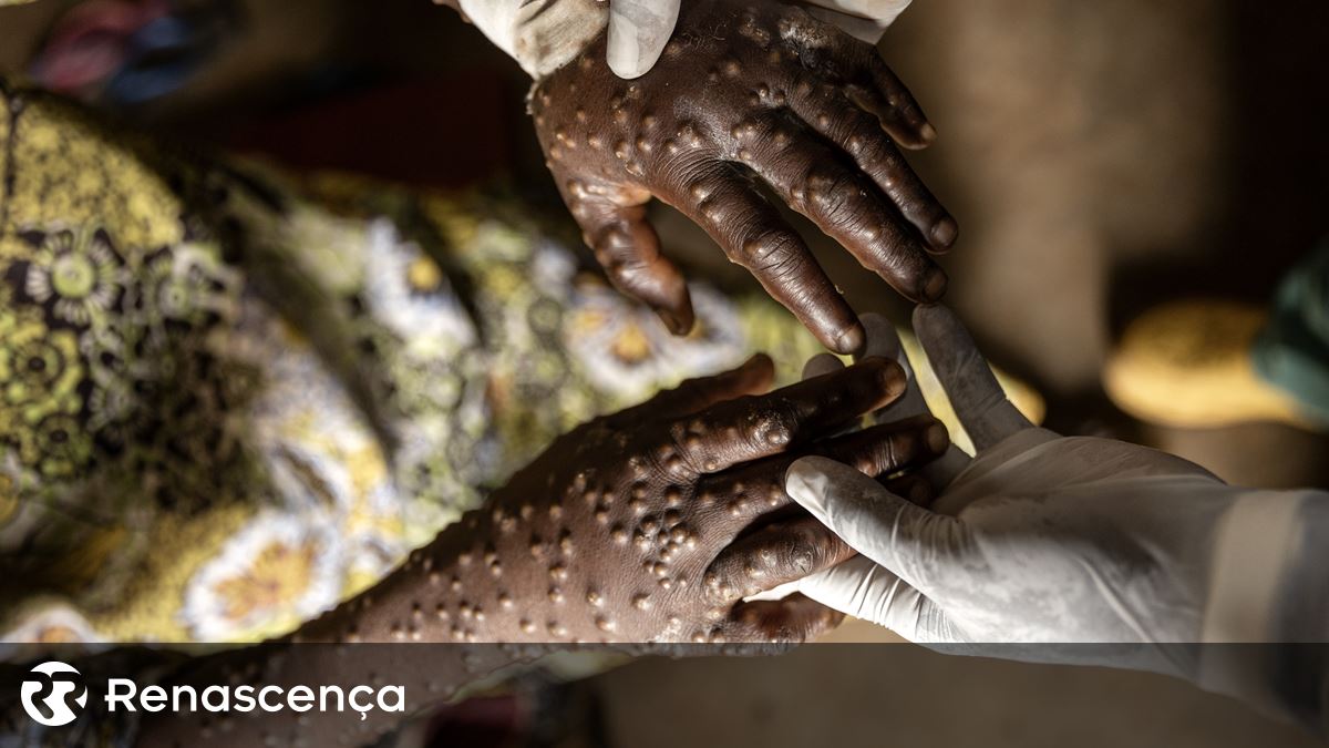 MPOX: Agentes infecciosos removem suposições populares em Portugal