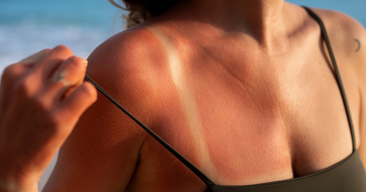 Sun Burns: Como identificá -los e tratá -los? – Fitness e bem-estar