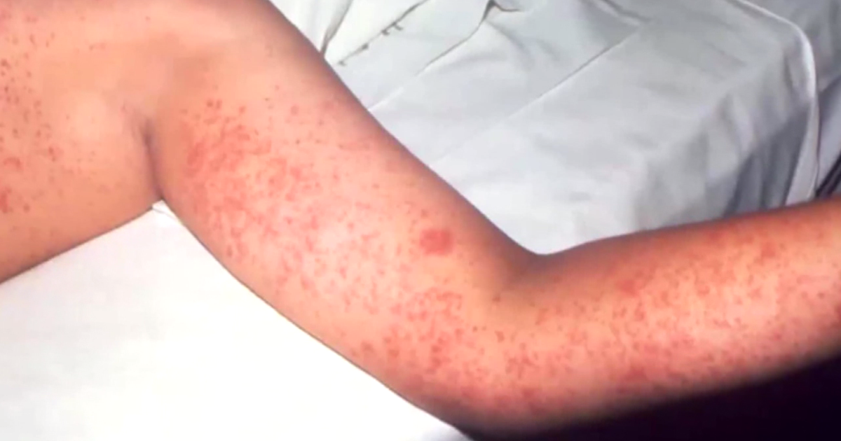 Weekly measles cases set new records in the worst outbreak since the 1990s