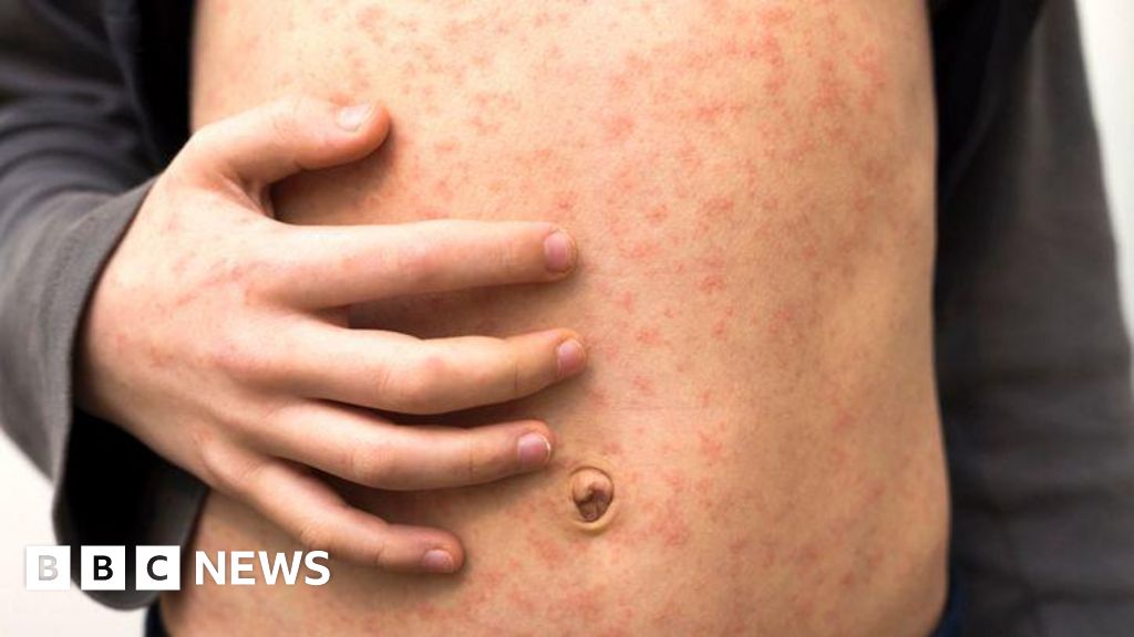 Measles warns vacationers heading to Europe