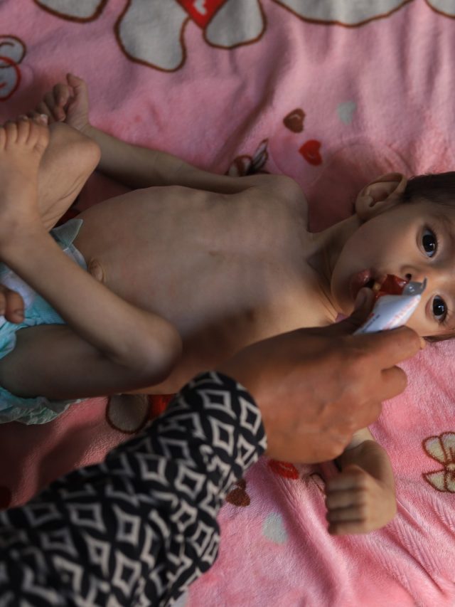 UN warns Gaza children about acute malnutrition | Hunger News
